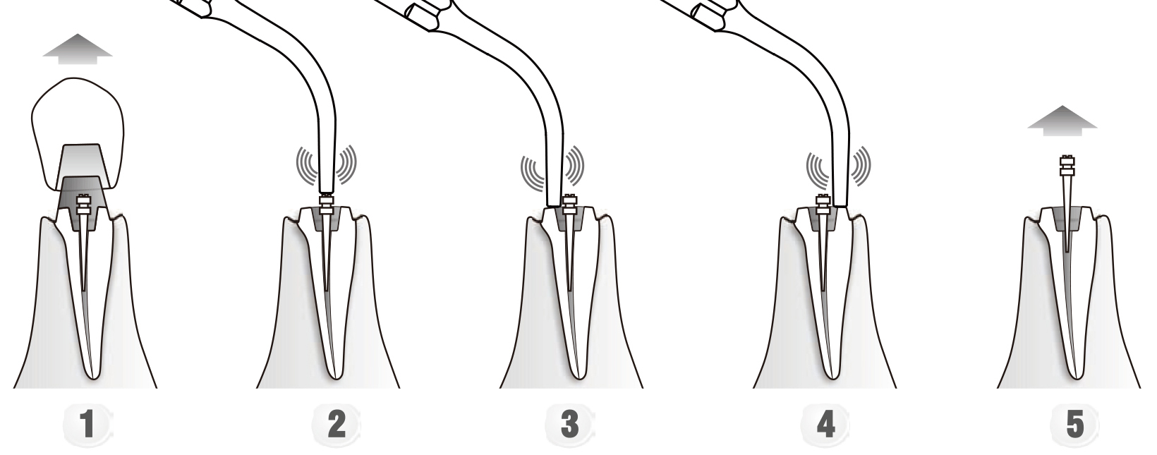 Сфера применения наконечника для скалера
